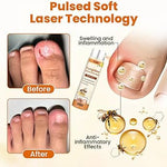 🐝FUNGI BEE - SPRAY - RESTAURADOR DE UÑAS ANTI-HONGOS CON VENENO DE ABEJA🐝